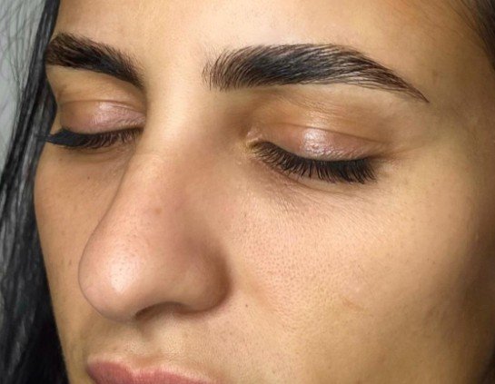 Brow Lift